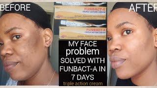 How to Get Ride Of Sunburn, Acne,Pimples in 7 Days/ FUNBACT-A TRIPLE ACTION CREAM #FUNBACT #skincare