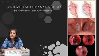 UNILATERAL CHOANAL ATRESIA | DR.SHAKUNTALA GHOSH | SRI RAMA ENT CARE CENTER