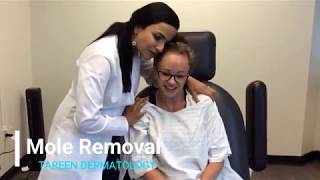 Mole Removal