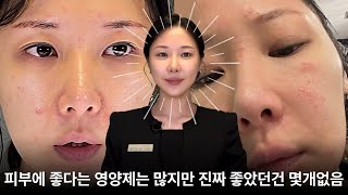 실제로 피부를 좋아지게 해준 영양제 3가지 #영양제추천