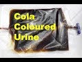Cola Coloured Urine