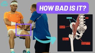 Expert Explains Rafa Nadal Hip Injury (Illiopsoas) & Return TImeline