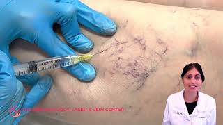 Sclerotherapy Varicose and Spider Vein Treatment | Dr. Shalini Gupta
