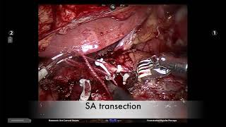 Robotic subtotal pancreatectomy, assisted by Huang's loop