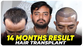 Hair Transplant in Coimbatore | Best Results \u0026 Cost of Hair Transplant in Coimbatore