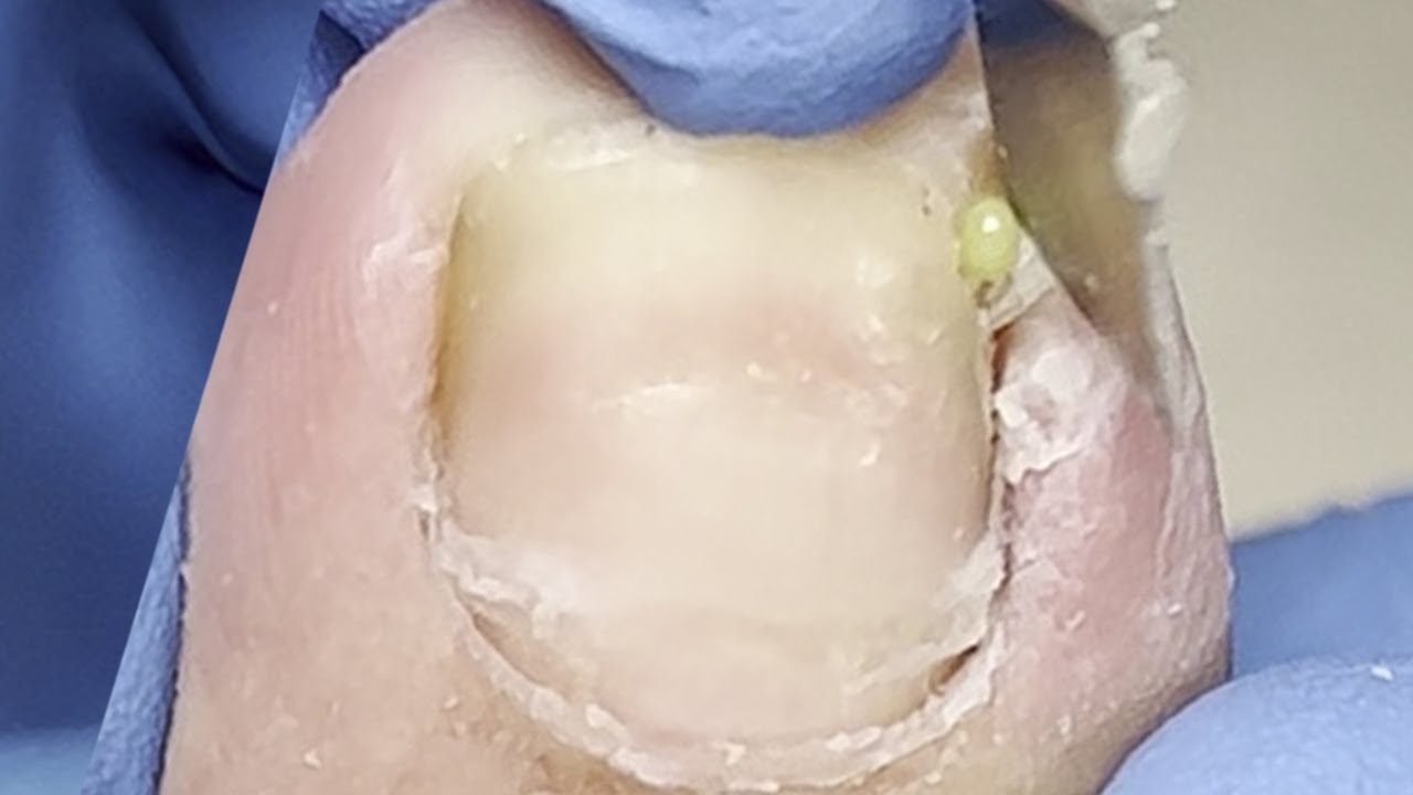 The soaked ingrown nail is easy to repair and solve the patient's pain【Xue Yidao】