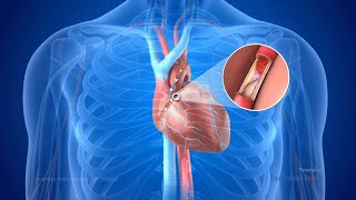 Heart Bypass Surgery | Step by step