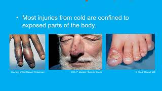EMT Chapter 32 Environmental Emergnecies