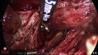 Revision Fundoplication Redo Surgery from Partial Dor's Fundoplication to Nissen's Complete Wrap