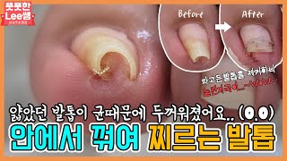 두꺼워진 발톱이 안에서 꺾여 찌르고있어요.  눌린자국이 헉!  ingrown toenail / ingrowing nail - 풋풋한리쌤 성수점 / 남양주호평점