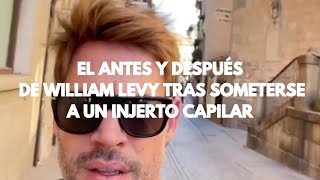 El antes y después de William Levy tras someterse a un injerto capilar