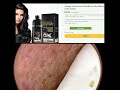 shocking cystic blackheads u0026 whiteheads extraction revealed new blackheads this week 121404