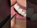 celebrity smiles over bleaching shade tabs dental dentist teeth shortvideo shorts smile