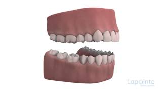 Malocclusion consequences - Lapointe dental centres