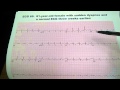 Shortness of Breath EKG ECG Electrocardiogram Uri Ben-Zur MD