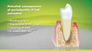 Solutions to Restore Gums and Bone at IMPrESS Perio Vancouver Burnaby Periodontist