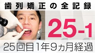 【歯列矯正25回目の調整日その1】装置が３ヵ所外れました…前歯の差し歯を交換する手順【1年9ヶ月経過レポート動画】