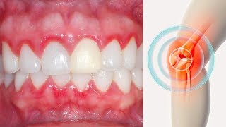 Swollen \u0026 Bleeding Gums Linked To Rheumatoid Arthritis