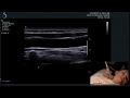 hot tips finding the vertebral artery with ultrasound