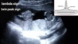 Dichorionic diamniotic twin pregnancy/lambda sign