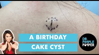 Birthday Cake Cyst With A Surprise You Can't Miss!