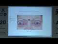 AIOC2020 - IC306. T2. Dr.Saurabh Kamal. Thyroid eye disease.