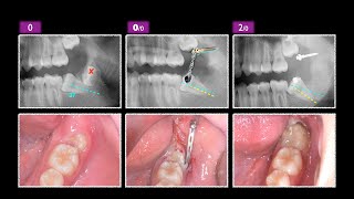 Lower Impacted Molar with Ramus Screw \u0026 aligner｜【Chris Chang Ortho】CC759