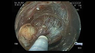 ESSD (endoscopic subserosal dissection) for gastric GIST