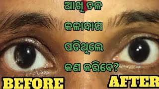 How To Remove Under Eye Dark Circle | ଆଖି ତଳ କଳା ପଡିଥିଲେ କଣ କରିବେ