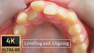 HOW #braces WORK - Levelling and Aligning in #orthodontics