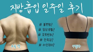 영상 보시고 수술하고 싶을 수도 있어요...! 상체 지방 흡입수술 7일차 리얼 후기🔥