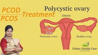 நீர் கட்டிக்கு சிகிச்சை முறைகள் | Treatment For PCOS / PCOD  | Dr.B.Yoga Vidhya