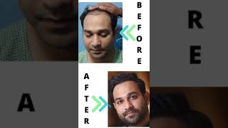🌟Best Hair Transplant Results with Before After Images | Total Grafts Implanted 5248 | After 2 years