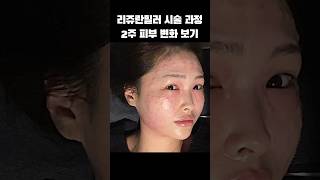 리쥬란힐러 시술 과정 ~ 2주 피부 변화 💉