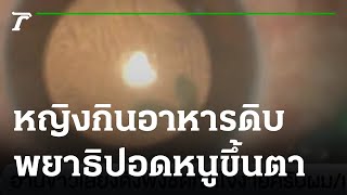 หญิง 40 ปี กินอาหารดิบ พยาธิปอดหนูขึ้นตา ตาบอด | 02-02-65 | ข่าวเย็นไทยรัฐ