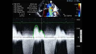 Mitral Regurgitation and PISA calculation