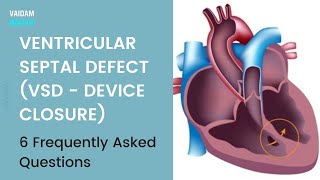 Ventricular septal defect(VSD)- 6 Frequently Asked Questions