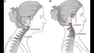 Craniocervical 