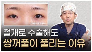 [풀린 눈 재수술 1편] 절개로 수술해도 풀리나요?  | 눈성형만 하는 온리아이성형외과