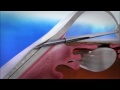 xen glaucoma stent animation