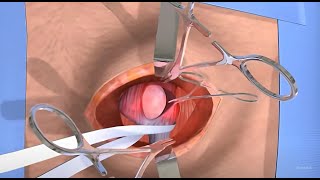 Inguinal hernia repair - 3D surgery animation