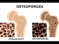 prirodni lek koji pomaze kod osteoporoze