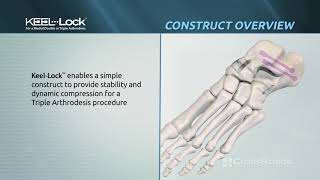 Keel-Lock™ Nitinol Implant System Animation