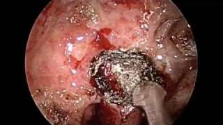 Cocaine Destruction of the Nose and Nasal cavity Requiring Sphenoidotomy