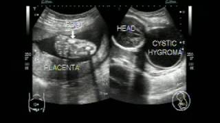 Ultrasound video of Cystic Hygroma