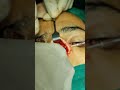 extracorporeal septoplasty.fixing neo septum in rhinoplasty.dr jalil mujawar