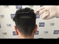 fue hair transplant 2200 grafts in nw lll pattern dr. juan couto fuexpert clinic madrid spain