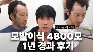 극한의 M자 이마 모발이식 1년 경과 후기 : 결과, 부작용 , 머리 상태, 약 복용 등 모든 것 솔직하게 답변드리겠습니다