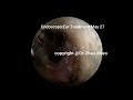 ear wax removal extraction with dr zhao 20210527