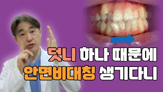 덧니때문에 생기는 안면비대칭, 어릴 때부터 잘 지켜봐야 하는 이유!